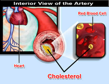 Atherosclerosis cure