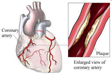 Coronary heart disease cure