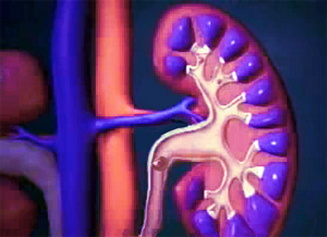 Glomerulonephritis cure