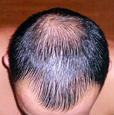 Hair loss prevention