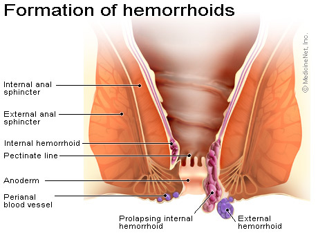 Hemorrhoid formation