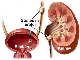 Nephrolithiasis treatment