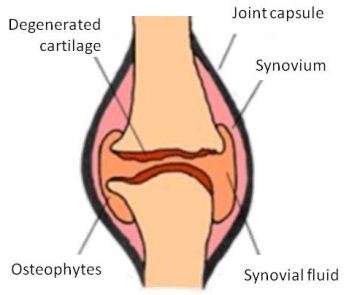 Rheumatism cure